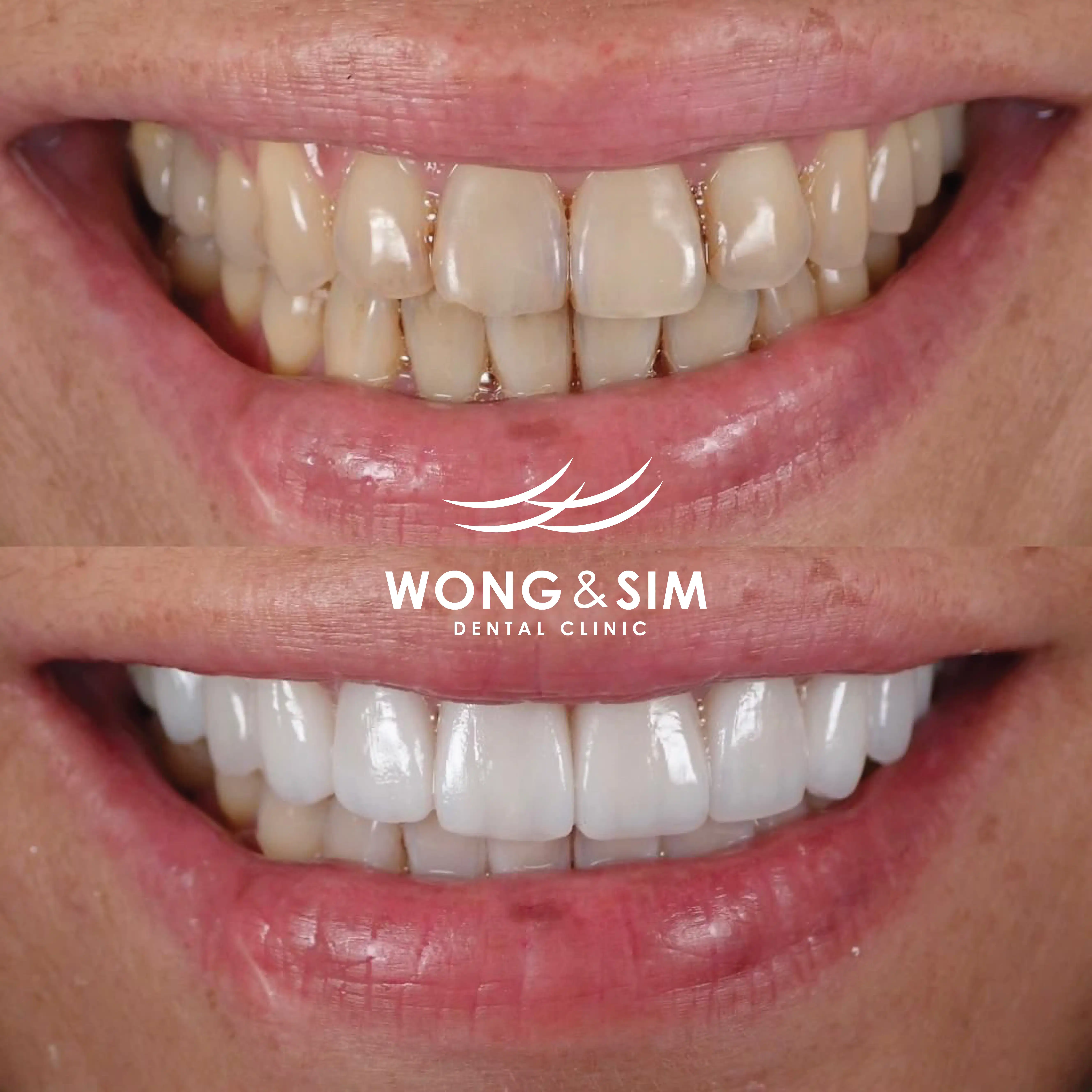 Patient 8 - Braces Before and After
